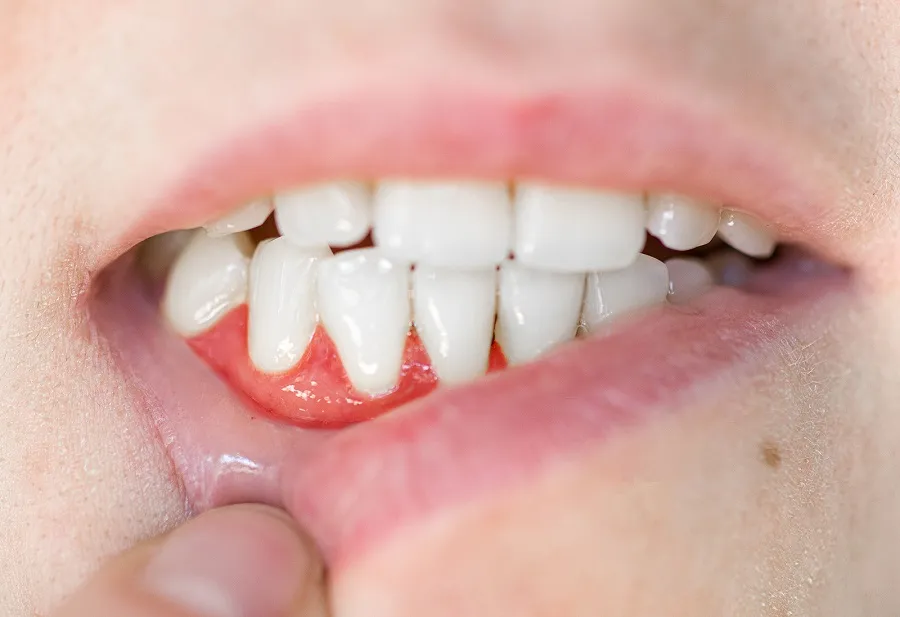 The Link Between Diabetes and Gum Disease Risk