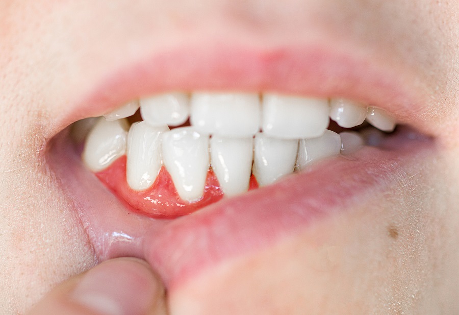 The Link Between Diabetes and Gum Disease Risk