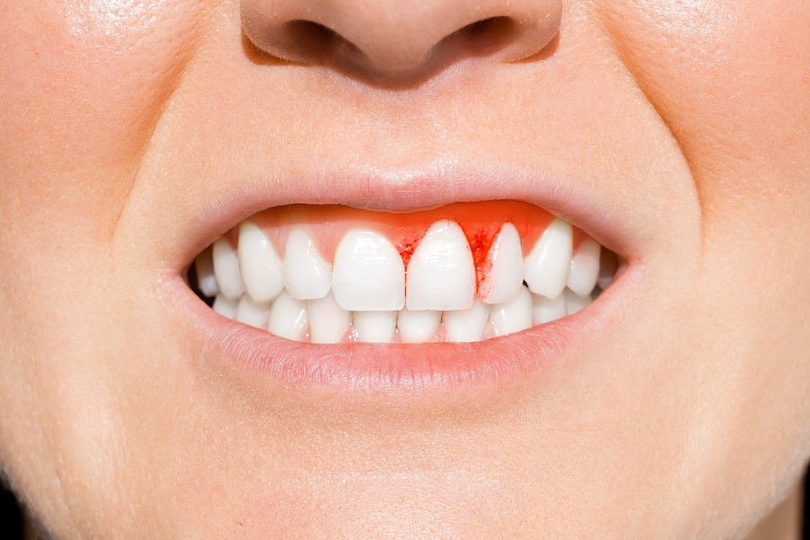 Gum Health Basics – Everything You Need To Know