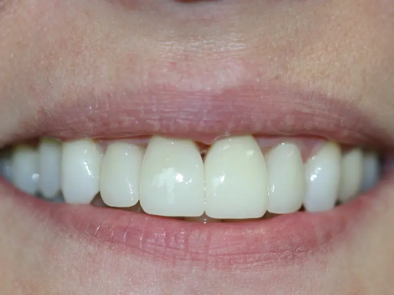 Dentistry Albany OR Crowns After Image