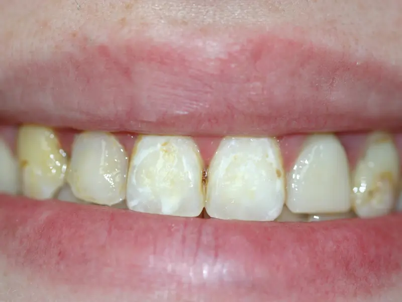 Dentistry Albany OR Crowns Before Image