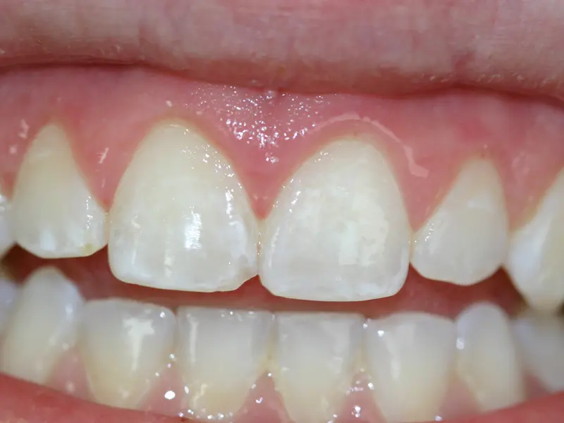 Dentistry Albany OR Gingivectomy After Image