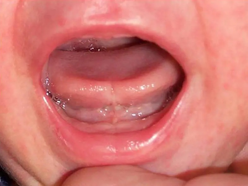Dentistry Albany OR Infant Tongue After Image
