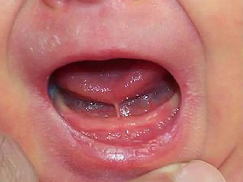 Dentistry Albany OR Infant Tongue Before Image