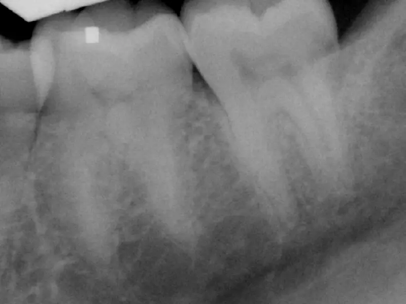 Dentistry Albany OR Occlusal Splint