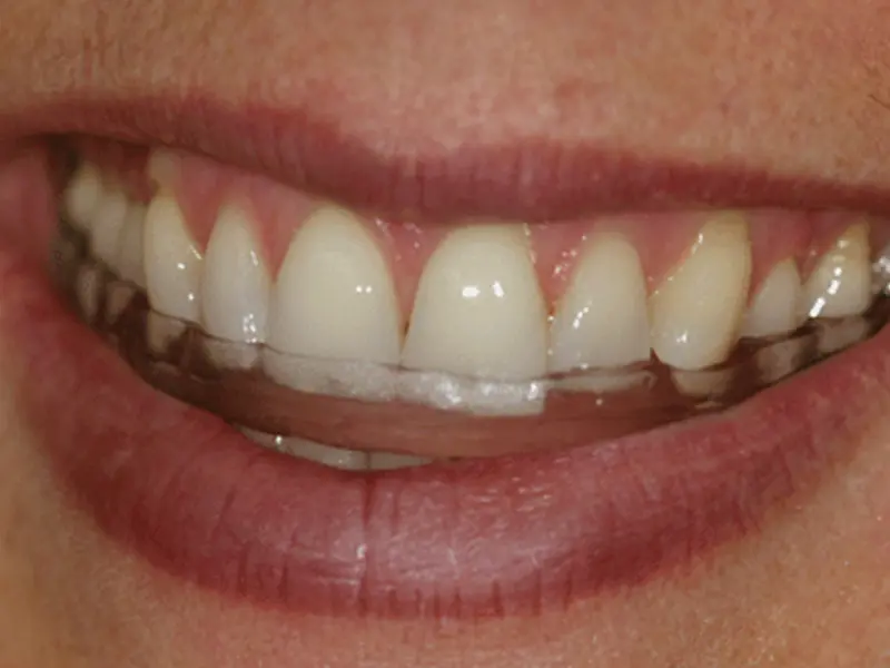 Dentistry Albany OR Occlusal Appliance Before Image