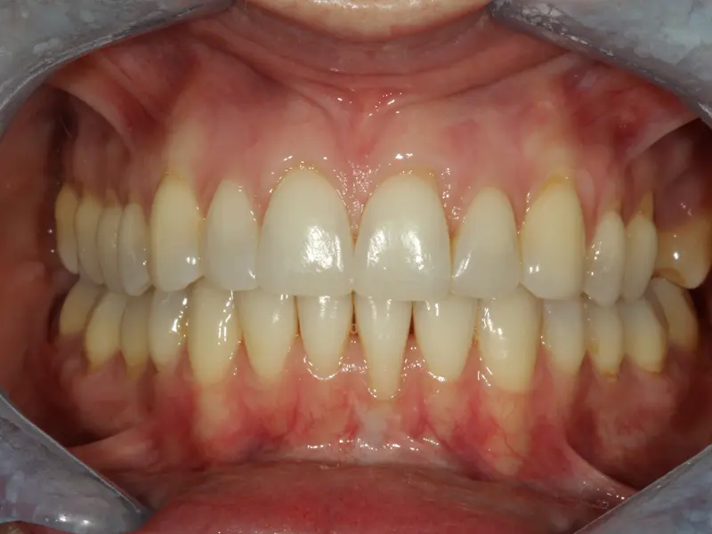 Dentistry Albany OR Ortho and Restorations After Image