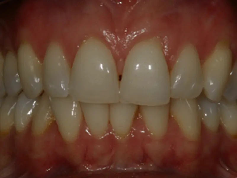 Dentistry Albany OR Ortho and Restorations Before Image