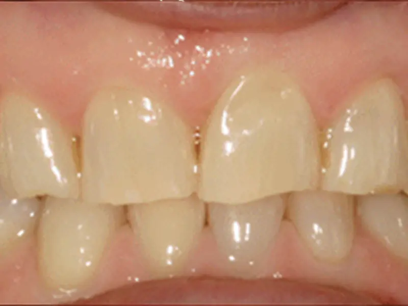 Dentistry Albany OR Veneers Before Image