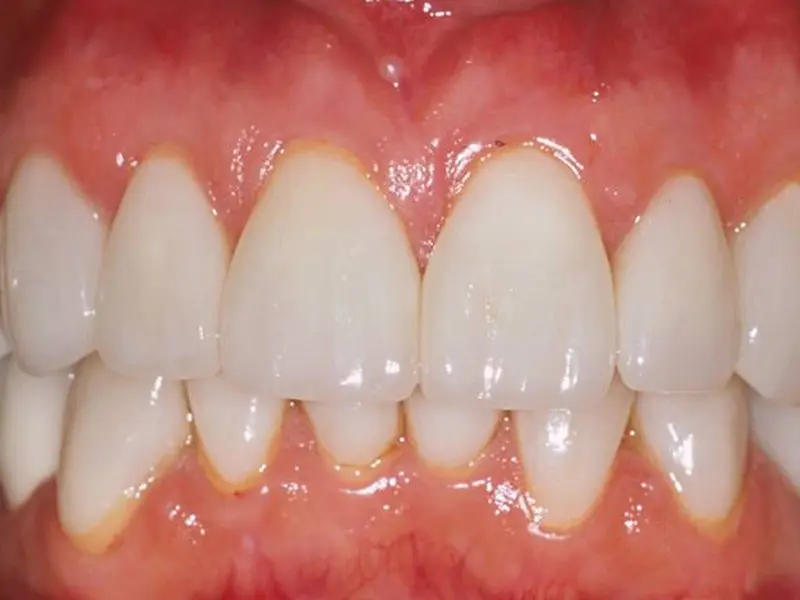 Dentistry Albany OR Veneers and Crowns After Image
